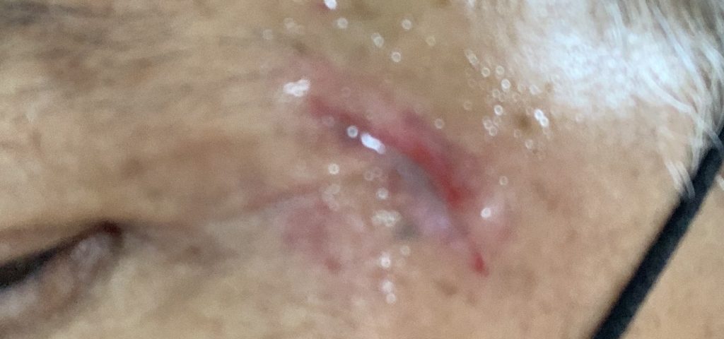 facial_wound facial_wound